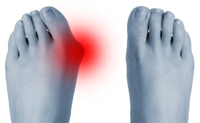 How do you get a bunion – and what can you do about it?